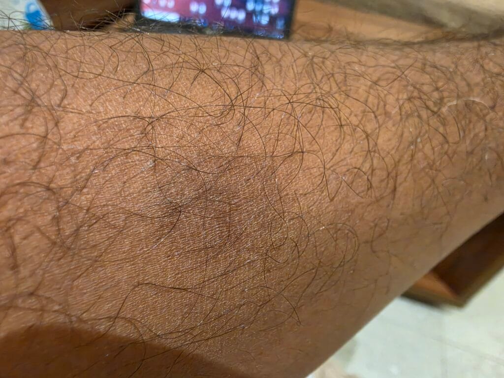 صورة نفس اليد بها إصابة فطرية Ringworm بعد ٣ شهور