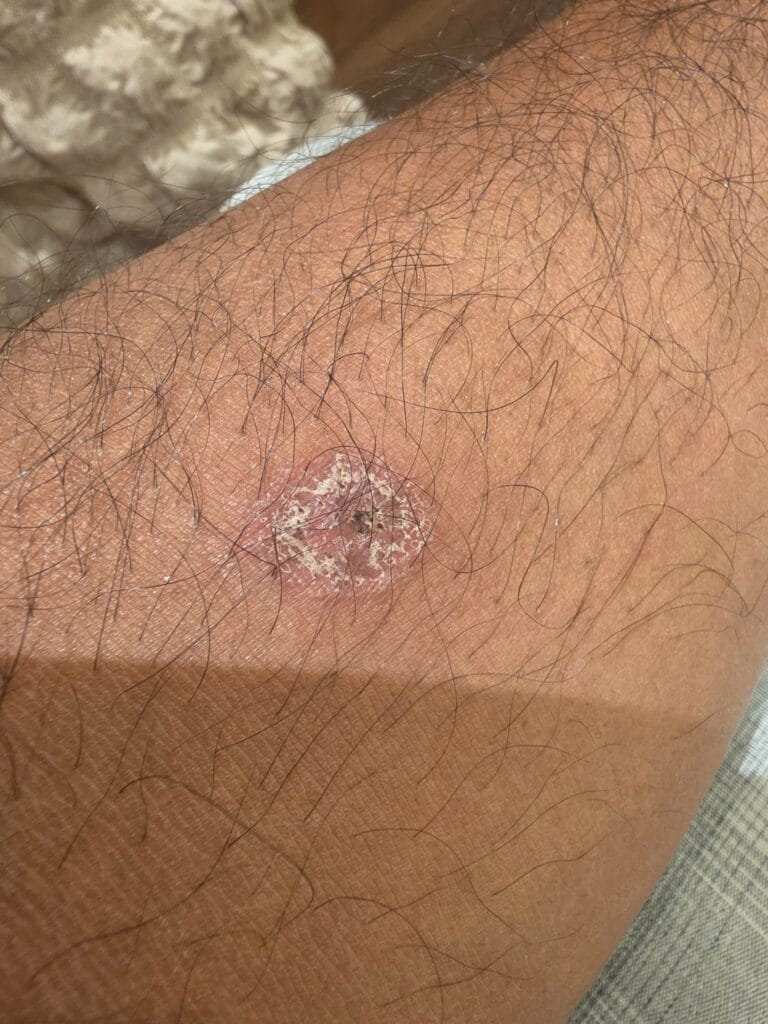 صورة يدي بها إصابة فطرية Ringworm